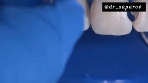 Эстетическая Реставрация передних зубов