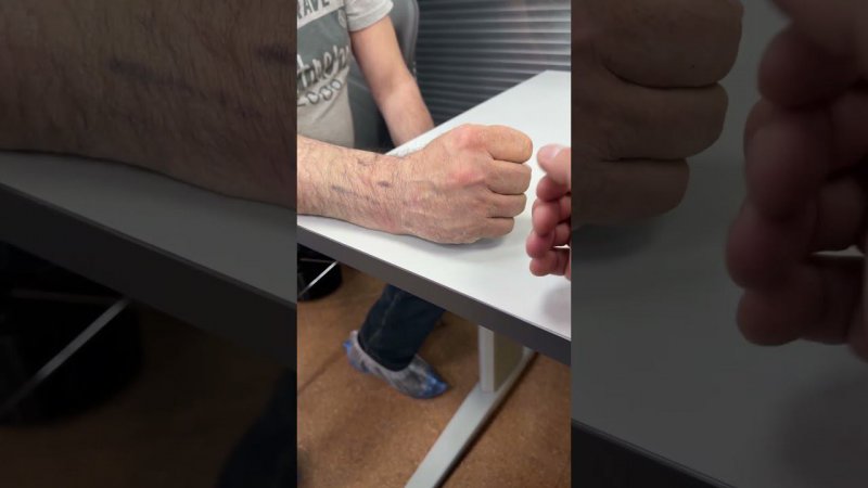 Функция Руки через 4 недели после перелома | Перелом Лучевой Кости