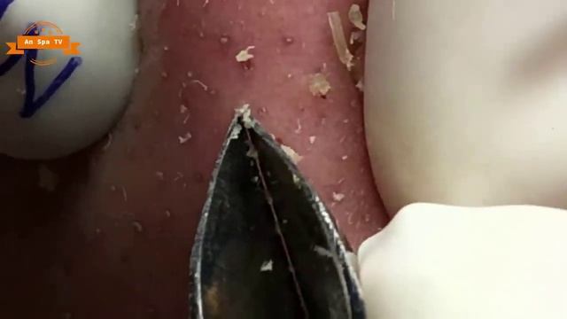 Выдавливание прыщей с носа и щек Spa G#087
