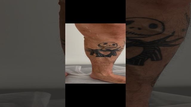 Варикоз у модели. Как лечить варикоз? Лечение варикоза - операция. Флеболог Москва. Флеболог смотреть онлайн