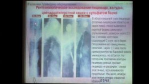 06 Румянцева ДЕ Дивертикулы пищевода в практике гастроэнтеролога