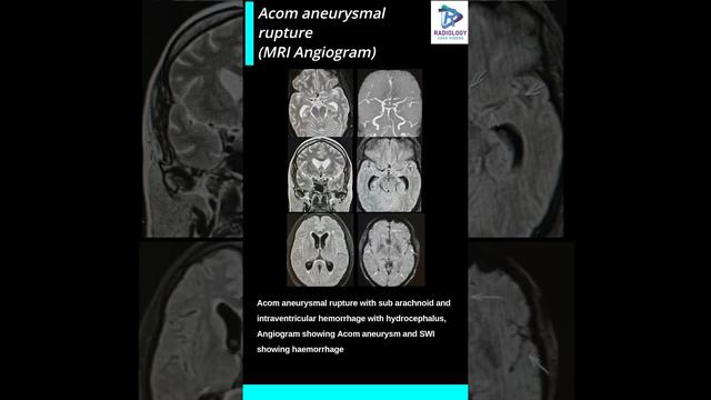 Acom aneurysmal rupture with subarachnoid haemorrhage