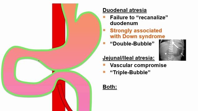 USMLE RX - 4.Желудочно-кишечный тракт - 2.Эмбриология - 2.Атрезия кишечника