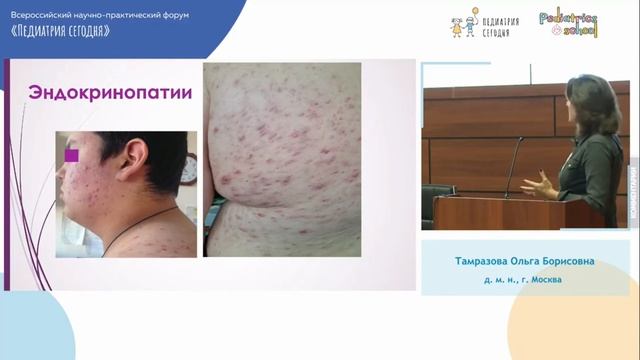 Угревая болезнь у детей и подростков