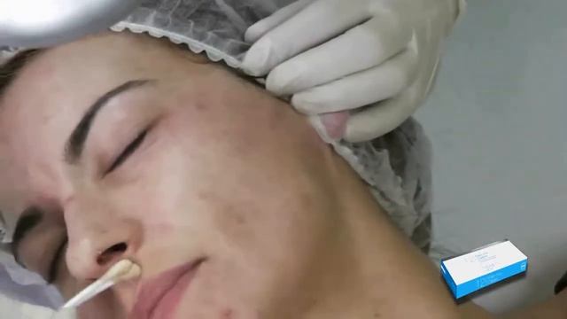 SkinTech® Easy TCA Classic application – Post Acne Scars on the face смотреть онлайн