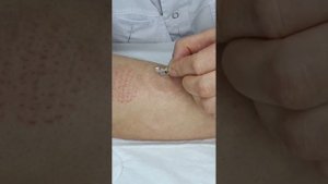 Хиджама самому себе за 7 минут