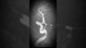 Эмболизация аневризмы внутренней сонной артерии