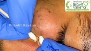 THE BLACKHEADS REMOVAL BY DR. LALIT KASANA PART 3 | DR. LALIT KASANA | PART 3 | 2020