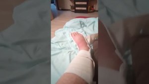 Откратый оскльчатый перелом таранной кости