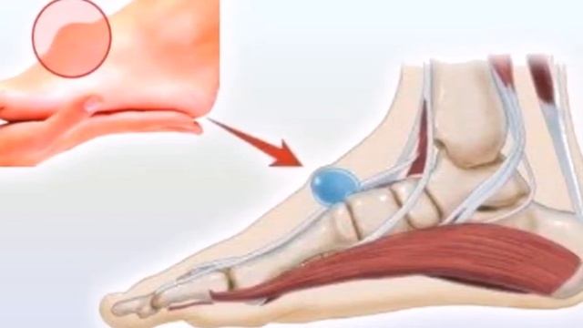 От шишке на ноге поможет избавиться лавровый лист смотреть онлайн