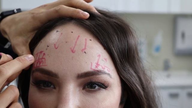 How to have frown and forehead anti-wrinkle injections without looking like Mr Spock!