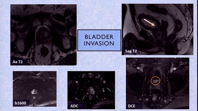 MRI First: The Role of MRI in Biopsy Naïve Patients