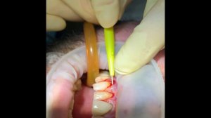 Работы наших специалистов. Пластика рецессии десны