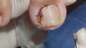 PODOLOGIA EM UNHA ENCRAVADA (OVERGROWN INFECTED INGROWN TOENAIL REMOVAL)