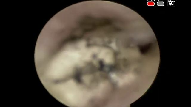 Хронический грибковый #отит отомикоз #воспаление #уха ЛОР КЛИНИКА ОБРАЗЦОВА смотреть онлайн