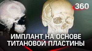 В Подмосковье пластину для трепанации черепа напечатали на 3D-принтере