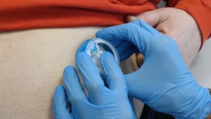 Установка инъекционного порта для введения инсулина в Ильинской больнице