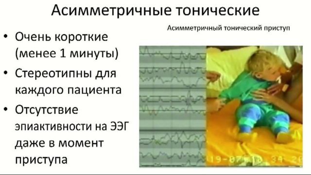 Лобная эпилепсия смотреть онлайн