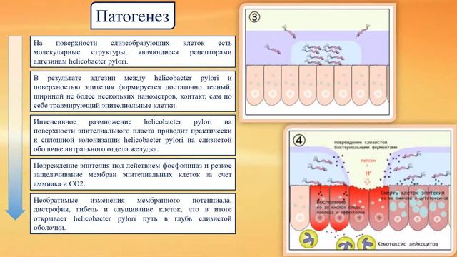 Helicobacter Pylori: история открытия, роль в патогенезе ЯБЖ