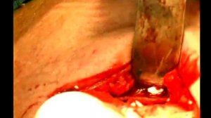 Цистэктомия, ЧЛХ, костный материал