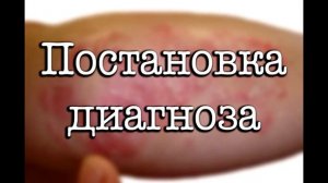 Себорейный псориаз: лечение, как выглядит, диагностика