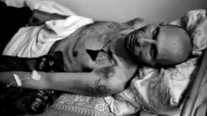 Что такое "туберкулез"?