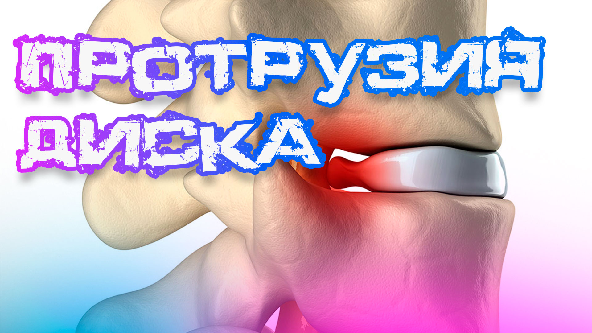 Протрузия это в стоматологии. Грыжа диска