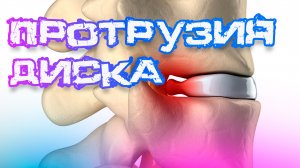 ?Протрузия диска: ЧТО это такое и КАК избавиться от БОЛИ? | Ответы на ваши вопросы.