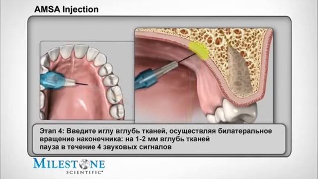 AMSA методика местного обезболивания с CompuDent STA