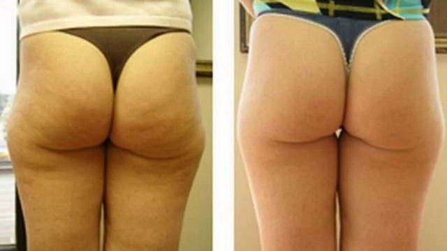 домашние скрабы от целлюлита смотреть онлайн