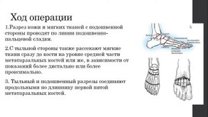 Ампутация стопы по Шарпу (трансметатарсальная ампутация)