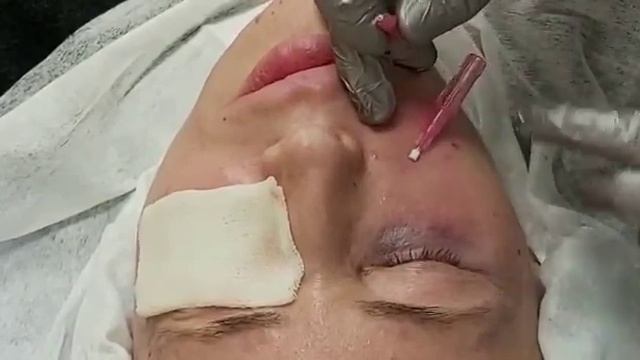 АирисКом студенты учатся: семинар установка 50 мезонитей, нижняя часть круговой мышцы глаз. смотреть онлайн