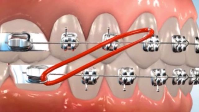 Class 2 Elastics - Easton Ortho 101 with Dr. Loftus смотреть онлайн