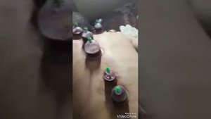 Хиджама, как я научилась ставить вакуумные банки