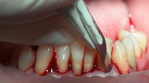 24 May. Mariia Nosova. Splinting and Periodontal Surgery. Part 3