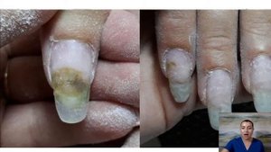Синегнойная палочка                Плесень на ногтях причина и лечение!