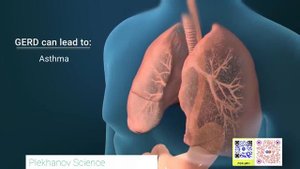 анатомия 3D причины GERD Гастроэзофагеальная рефлюксная болезнь Изжога
