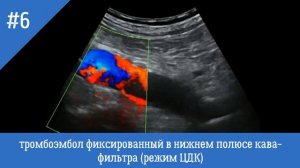 УЗИ сосудов. Тромбоэмбол фиксированный в нижнем полюсе кава - фильтра. Режим ЦДК.