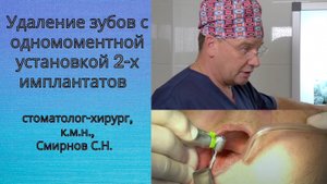 Установка двух имплантатов при полной адентии.