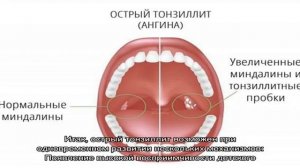 Признаки и симптомы гнойной ангины