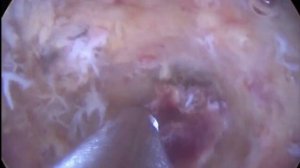 Удаление плацентарного полипа шейвером Bigatti. Placental polyp removal