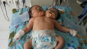 B УЗБЕКИСТАНЕ РОДИЛИСЬ СAМЫЕ НEОБЫЧНЫЕ СИАМСКИЕ БЛИЗНЕЦЫ хлеб