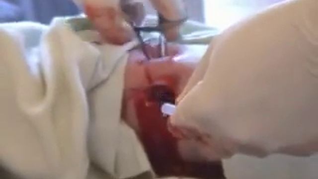 Дренирование раны Wound drainage