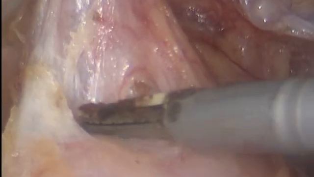 Миома матки больших размеров. Лапароскопическая тотальная гистерэетомия