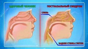 Что такое постназальный синдром?