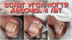 Болит угол ногтя у девочки 11 лет / Вросший ноготь у ребенка / Болит палец у ребенка  что делать /