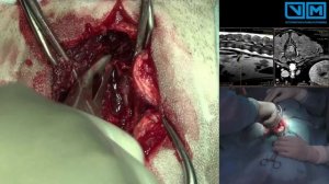 Удаление новообразования к поясничном отделе позвоночника.