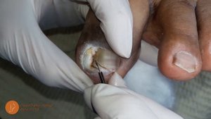 Ingrown toenail & granuloma (1st part) #podologiaintegral