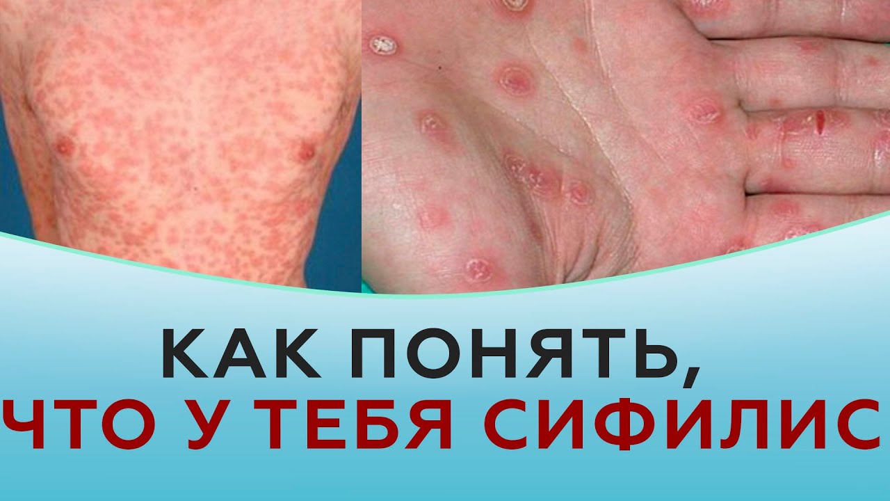 Как понять, что у тебя сифилис.