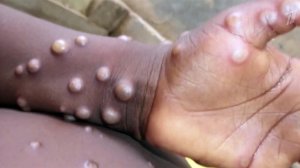 Минобороны РФ предлагает ВОЗ рассмотреть связь оспы обезьян и биологической программы США